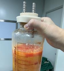 仁怀水动力吸脂手术要做多久？